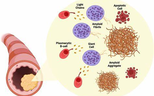 NEJM综述：淀粉样变性的发病机制、研究和治疗